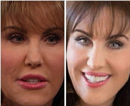 A before and after picture of Robin McGraw's changing nose.